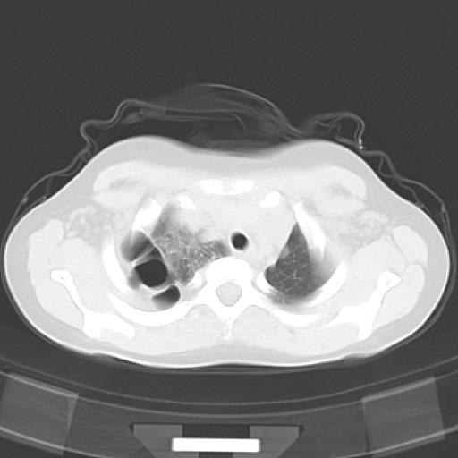 File:Bochdalek diaphragmatic hernia (Radiopaedia 38866-41059 Axial lung window 4).jpg