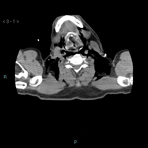 Boerhaave syndrome (Radiopaedia 27683-27897 oral contrast 1).jpg