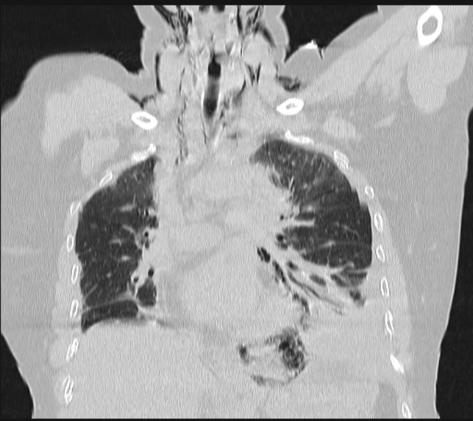 Boerhaave syndrome (Radiopaedia 45644-49799 Coronal lung window 32).jpg