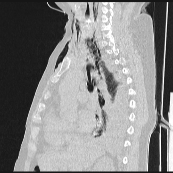 Boerhaave syndrome (Radiopaedia 45644-49799 Sagittal lung window 35).jpg