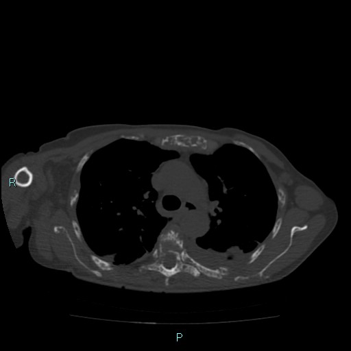 File:Bone metastases from untreated breast cancer (Radiopaedia 42973-46219 Axial bone window 35).jpg