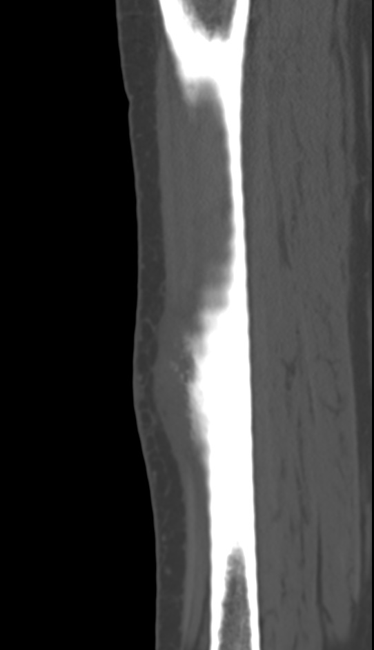 Bone metastasis - tibia (Radiopaedia 57665-64609 Sagittal bone window 109).jpg
