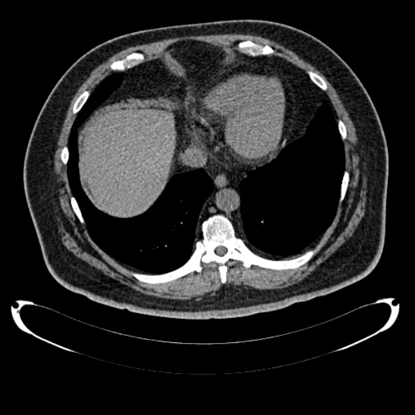 File:Bosniak renal cyst - type IV (Radiopaedia 24244-24518 Axial non-contrast 28).jpg