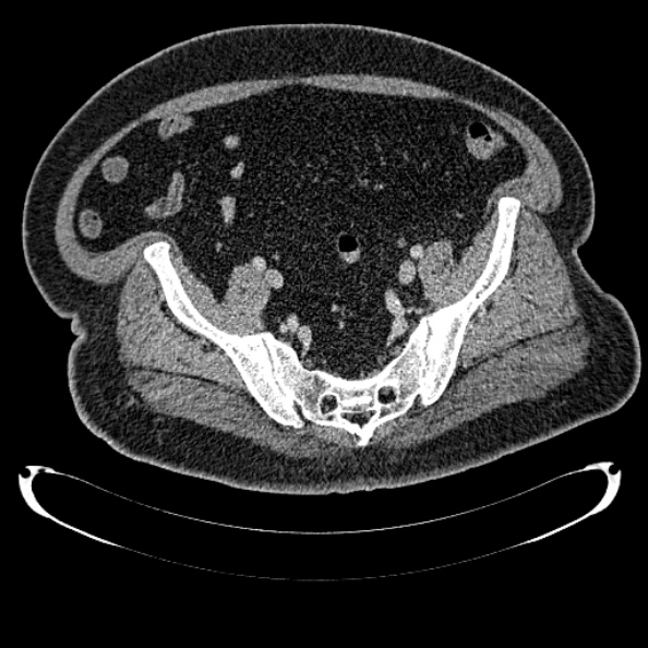 Bosniak renal cyst - type IV (Radiopaedia 24244-24518 C 318).jpg