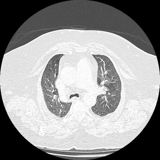 Bovine aortic arch - right internal mammary vein drains into the superior vena cava (Radiopaedia 63296-71875 Axial lung window 51).jpg