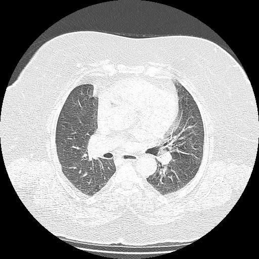 Bovine aortic arch - right internal mammary vein drains into the superior vena cava (Radiopaedia 63296-71875 Axial lung window 77).jpg