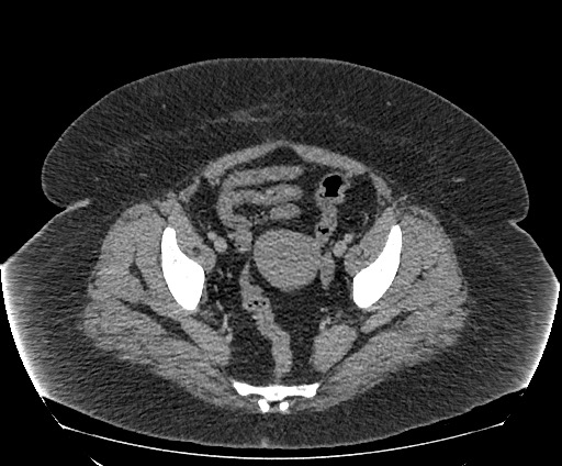 Bowel and splenic infarcts in acute lymphocytic leukemia (Radiopaedia 61055-68913 A 108).jpg