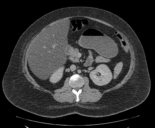 Bowel and splenic infarcts in acute lymphocytic leukemia (Radiopaedia 61055-68913 A 58).jpg