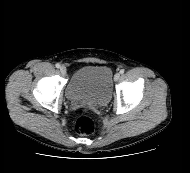 Bowel obstruction from colon carcinoma (Radiopaedia 22995-23028 A 79).jpg