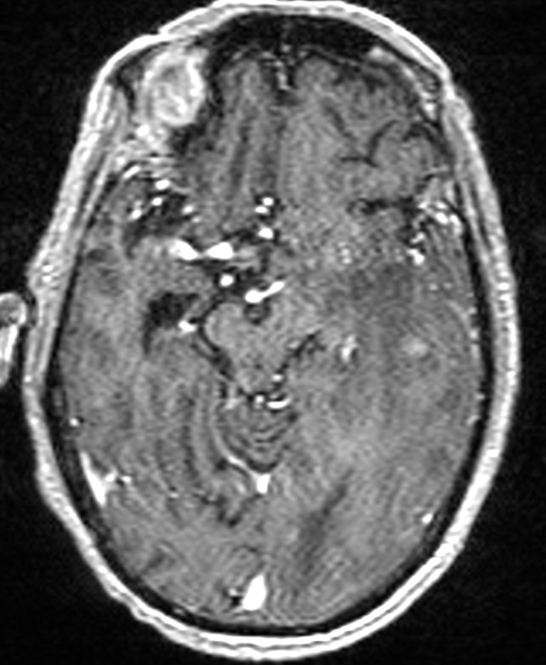 Brain abscess with dual rim sign (Radiopaedia 87566-103938 Axial T1 C+ 71).jpg
