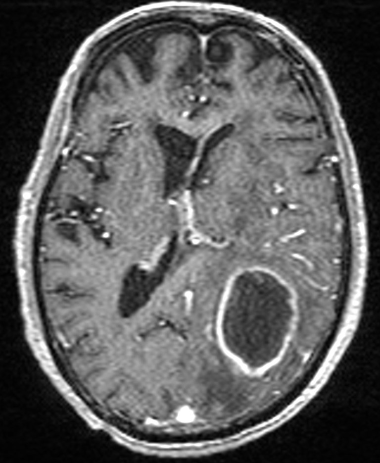 Brain abscess with dual rim sign (Radiopaedia 87566-103938 Axial T1 C+ 93).jpg