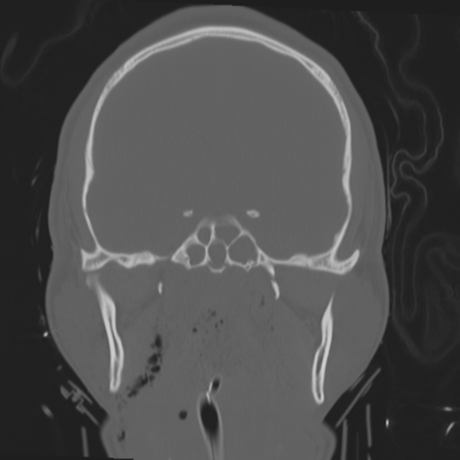 Brain contusions, internal carotid artery dissection and base of skull fracture (Radiopaedia 34089-35339 Coronal bone window 33).png