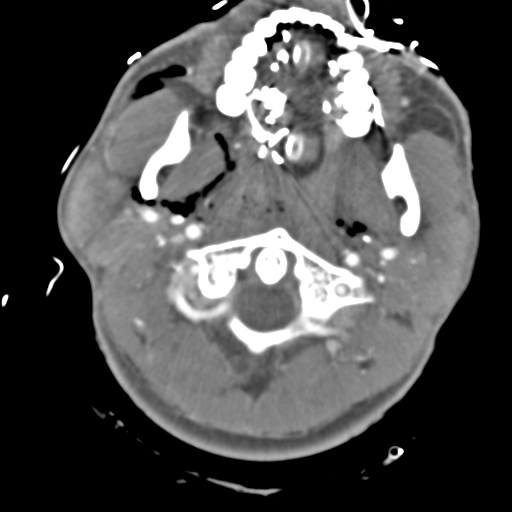 File:Brain contusions, internal carotid artery dissection and base of skull fracture (Radiopaedia 34089-35339 D 55).png