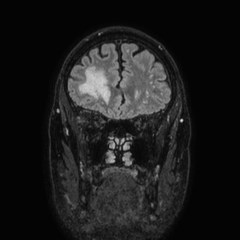 Brain metastases from lung cancer (Radiopaedia 83839-99028 Coronal FLAIR 18).jpg