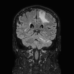 Brain metastases from lung cancer (Radiopaedia 83839-99028 Coronal FLAIR 52).jpg