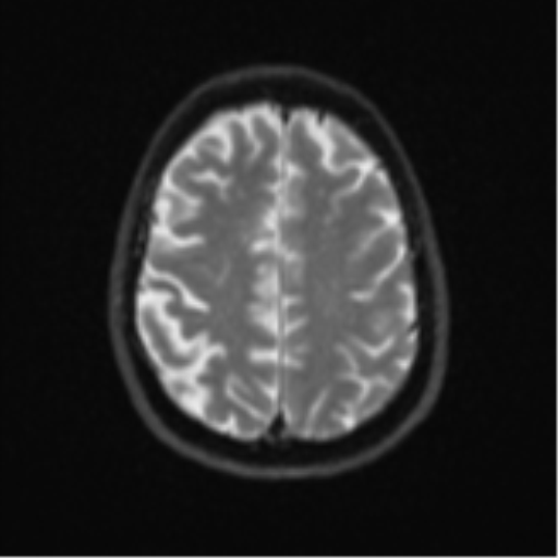 Brain metastasis (large cystic mass) (Radiopaedia 47497-52107 Axial DWI 21).png
