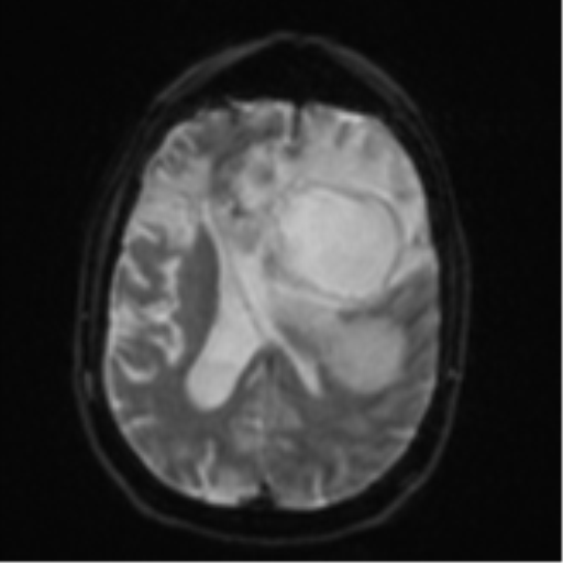 Brain metastasis (lung cancer) (Radiopaedia 48289-53179 Axial DWI 17).png