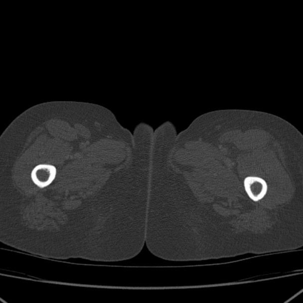 Breast cancer metastases - hepatic and skeletal (Radiopaedia 34201-35461 Axial bone window 117).jpg