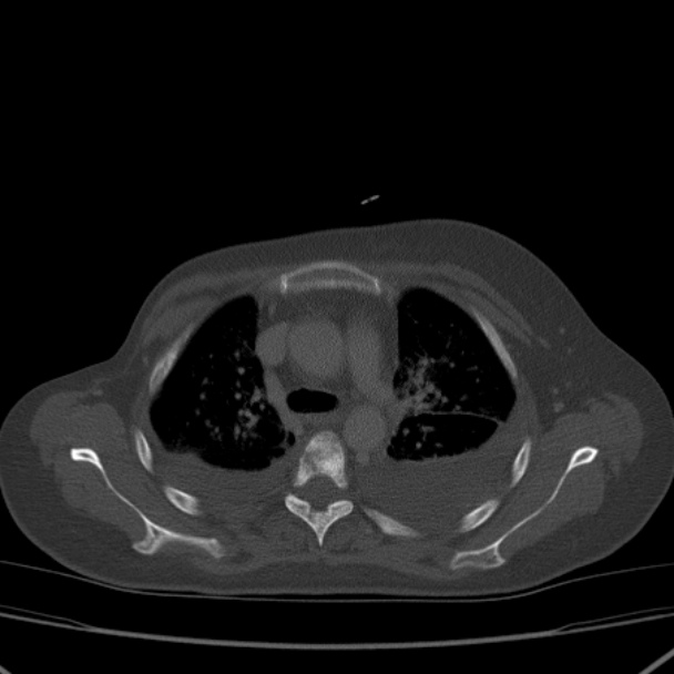 Breast cancer metastases - hepatic and skeletal (Radiopaedia 34201-35461 Axial bone window 14).jpg