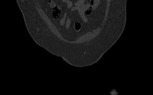 File:Breast carcinoma with pathological hip fracture (Radiopaedia 60314-67993 Coronal bone window 31).jpg