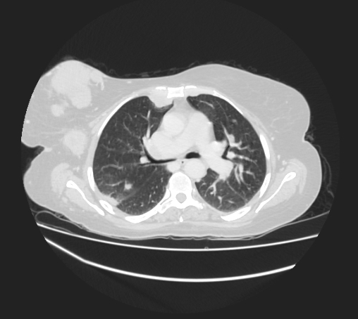 Breast metastases from facial malignant melanoma (Radiopaedia 60316-67975 Axial lung window 44).jpg