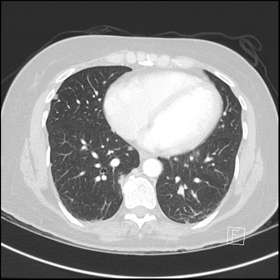 File:Breast metastases from renal cell cancer (Radiopaedia 79220-92225 Axial lung window 57).jpg