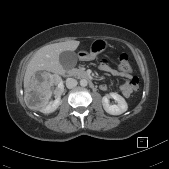 Breast metastases from renal cell cancer (Radiopaedia 79220-92225 C 41).jpg