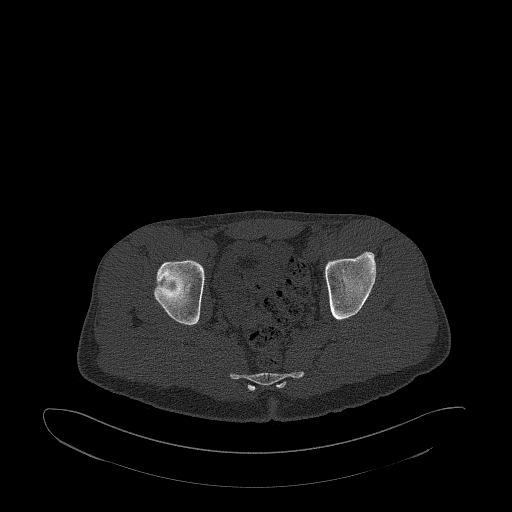 Brodie abscess- femoral neck (Radiopaedia 53862-59966 Axial bone window 117).jpg
