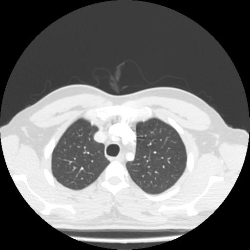 Bronchial carcinoid (Radiopaedia 80013-93291 Axial lung window 13).jpg