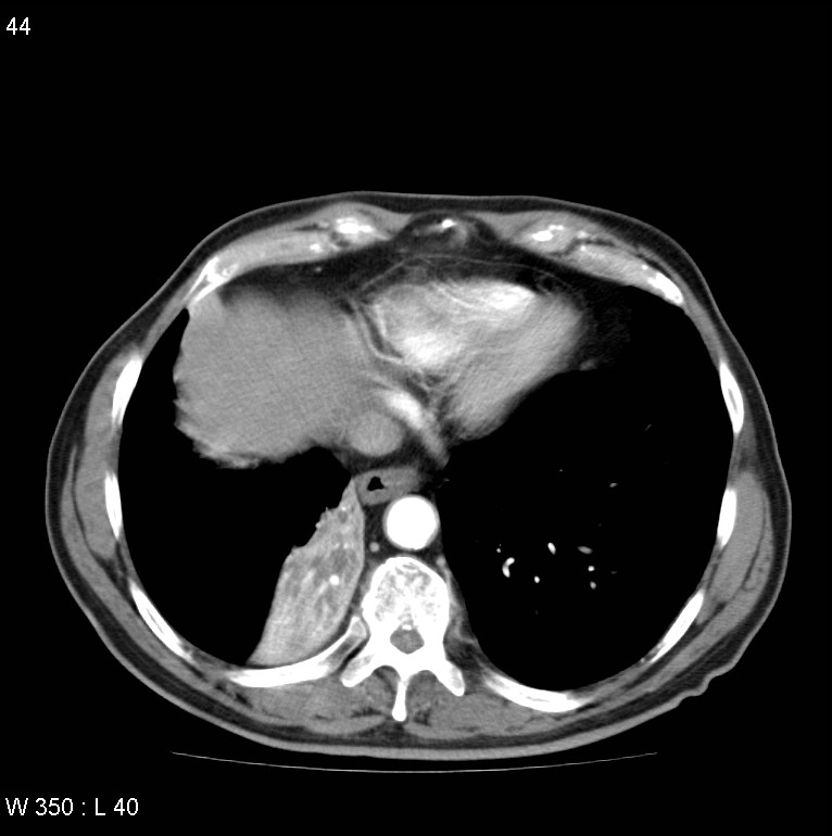 Bronchial carcinoid tumor with right lower lobe collapse (Radiopaedia 29060-29422 A 43).jpg