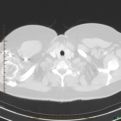 Bronchial diverticula (Radiopaedia 79512-92675 Axial lung window 1).jpg