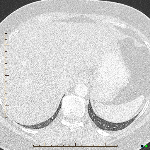 Bronchial diverticula (Radiopaedia 79512-92676 Axial lung window 194).jpg