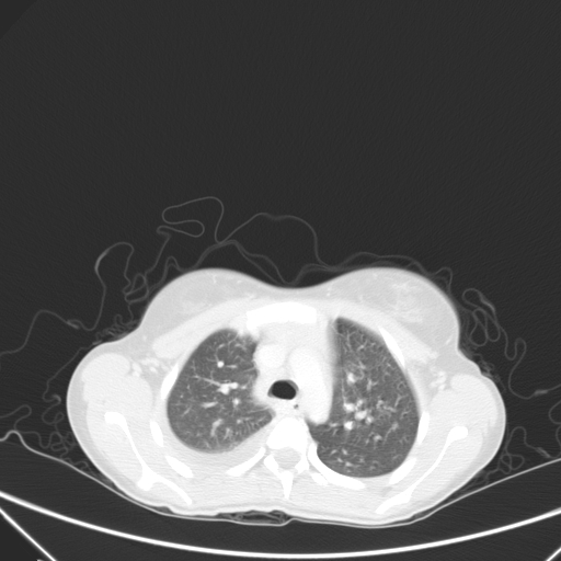 Bronchial mucoepidermoid carcinoma (Radiopaedia 57023-63895 Axial lung window 30).jpg