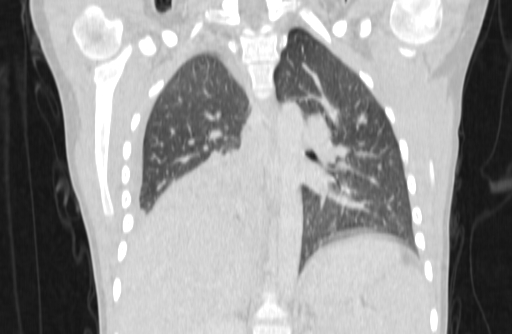 Bronchial mucoepidermoid carcinoma (Radiopaedia 57023-63895 Coronal lung window 39).jpg