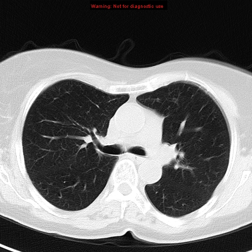 File:Bronchoalveolar carcinoma (BAC) (Radiopaedia 13436-13392 Axial lung window 21).jpg