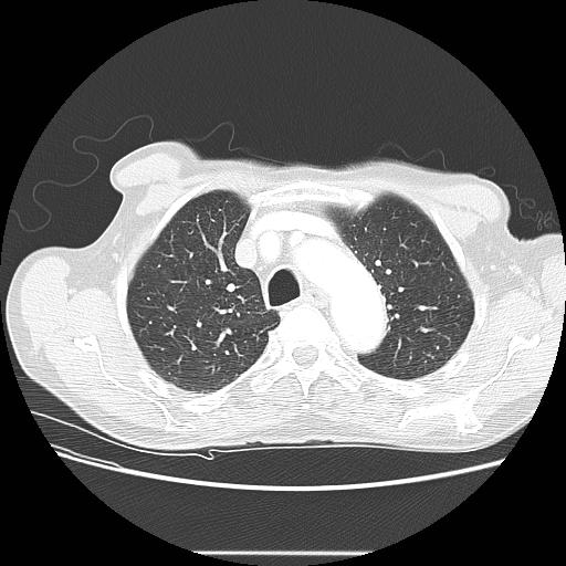 File:Bronchocele (Radiopaedia 17097-16795 Axial lung window 30).jpg