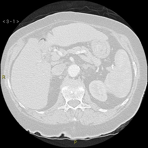 Bronchogenic carcinoma as an incidental finding (Radiopaedia 16453-16130 Axial lung window 1).jpg