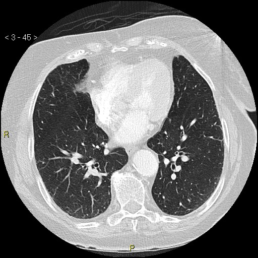 Bronchogenic carcinoma as an incidental finding (Radiopaedia 16453-16130 Axial lung window 45).jpg