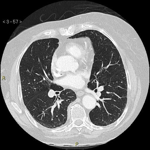 Bronchogenic carcinoma as an incidental finding (Radiopaedia 16453-16130 Axial lung window 57).jpg