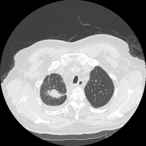 Bronchogenic carcinoma with metastatic lymphadenopathy (Radiopaedia 37671-39569 Axial lung window 11).jpg