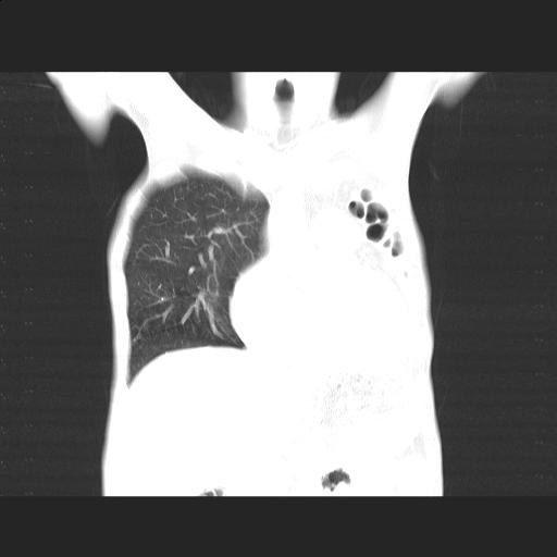 File:Bronchopleural fistula secondary to tuberculosis (Radiopaedia 20415-20322 Coronal lung window 6).jpg