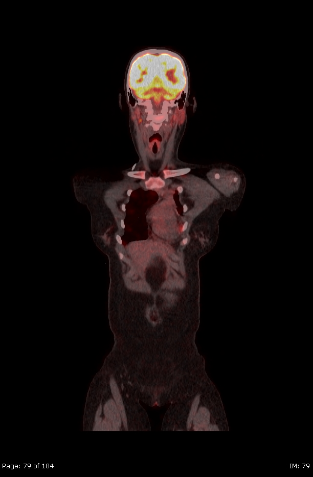 Brown fat uptake (FDG PET-CT) (Radiopaedia 77392-89513 Fused coronal 37).jpg