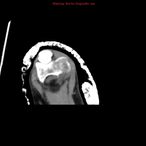 Brown tumor (Radiopaedia 12460-12694 Axial non-contrast 136).jpg