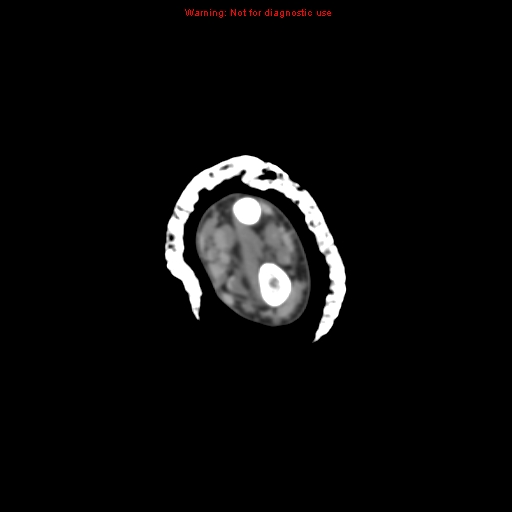 Brown tumor (Radiopaedia 12460-12694 Axial non-contrast 32).jpg