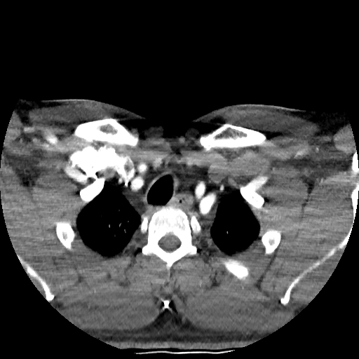 Buccal fat pad arteriovenous malformation (Radiopaedia 70936-81144 D 32).jpg