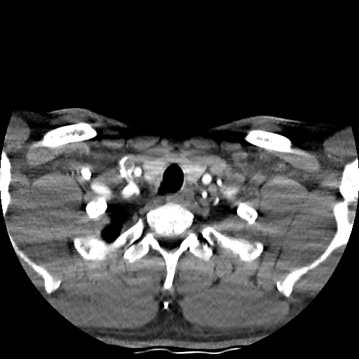 Buccal fat pad arteriovenous malformation (Radiopaedia 70936-81144 D 45).jpg