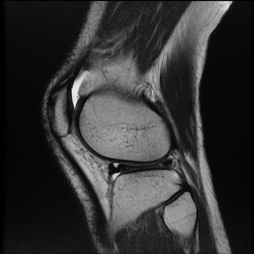 File:Bucket-handle meniscus tear (Radiopaedia 65700-74809 Sagittal T2 20).jpg