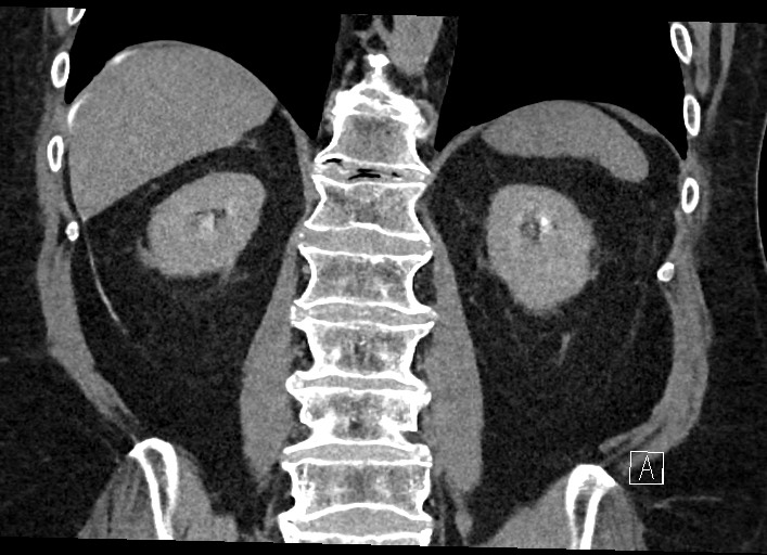 Buried bumper syndrome - gastrostomy tube (Radiopaedia 63843-72577 Coronal Inject 96).jpg