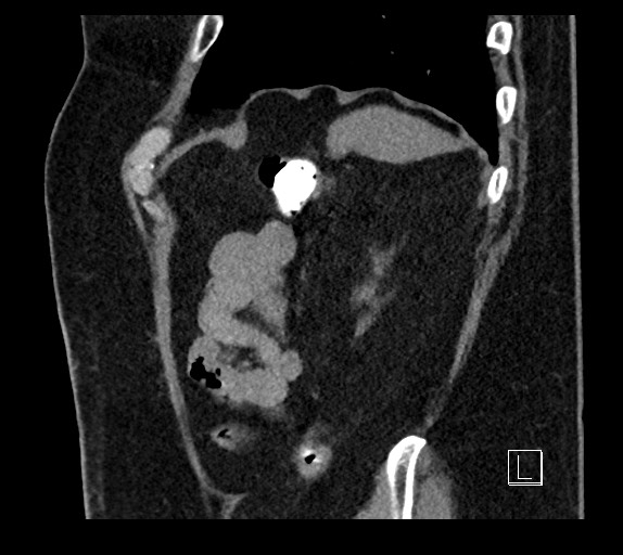 Buried bumper syndrome - gastrostomy tube (Radiopaedia 63843-72577 Sagittal Inject 20).jpg