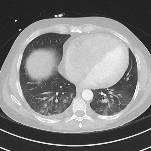Burkitt lymphoma (Radiopaedia 34686-36121 Axial lung window 33).png
